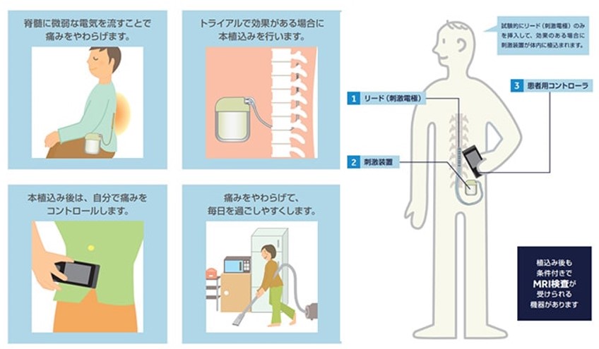 経皮的神経電気刺激はどのように投与されますか?